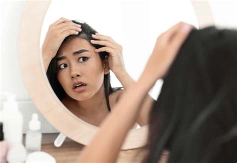 Ano Ang Alopecia: Alamin Ang Mga Fact Tungkol Sa Kondisyong Ito.